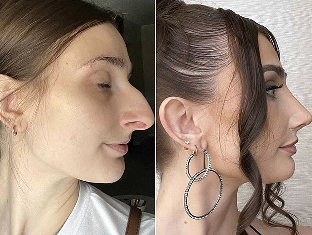 Plastika nosu mi zlepšila kvalitu života, říká žena