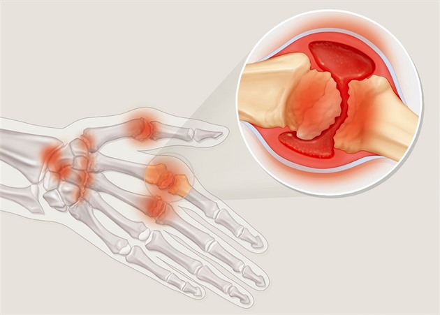 Artritida netrápí jen staré. Co dělat, když klouby bolí a tělo tuhne