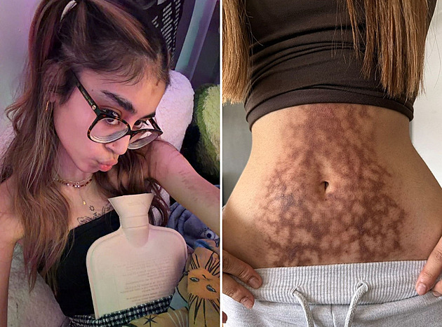 Závislost na ohřívací láhvi způsobila ženě nenávratné zohyzdění